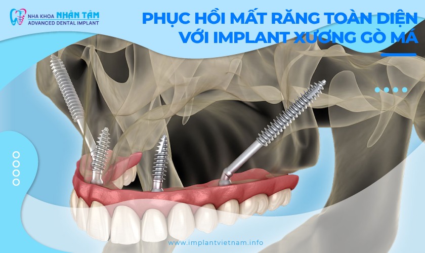 Phục hồi mất răng toàn diện với Implant xương gò má