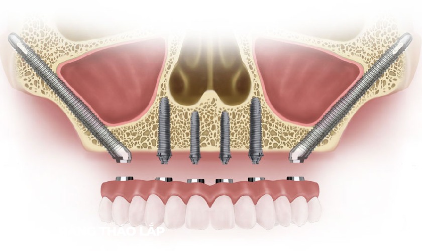 Implant xương gò má là loại Implant dài hơn so với Implant truyền thống