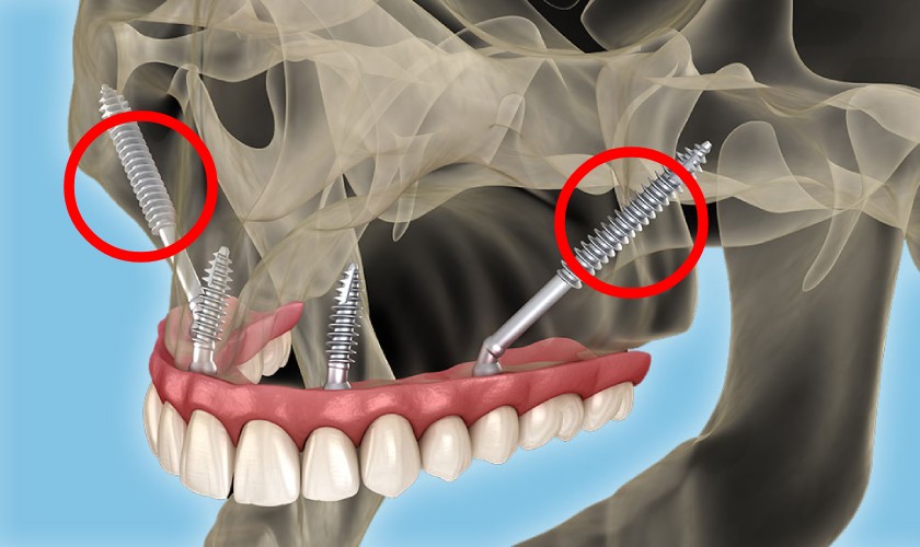 Implant xương gò má là cứu cánh cho những trường hợp tiêu xương nghiêm trọng
