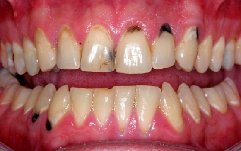 Răng bị đen ở kẽ - Nguyên nhân và cách khắc phục