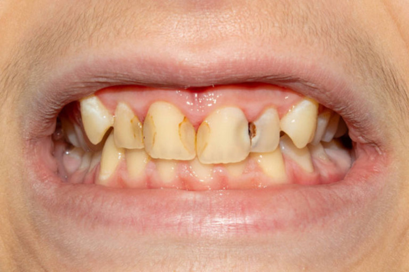 Sâu răng là một trong những nguyên nhân chính gây ra tình trạng đen kẽ răng