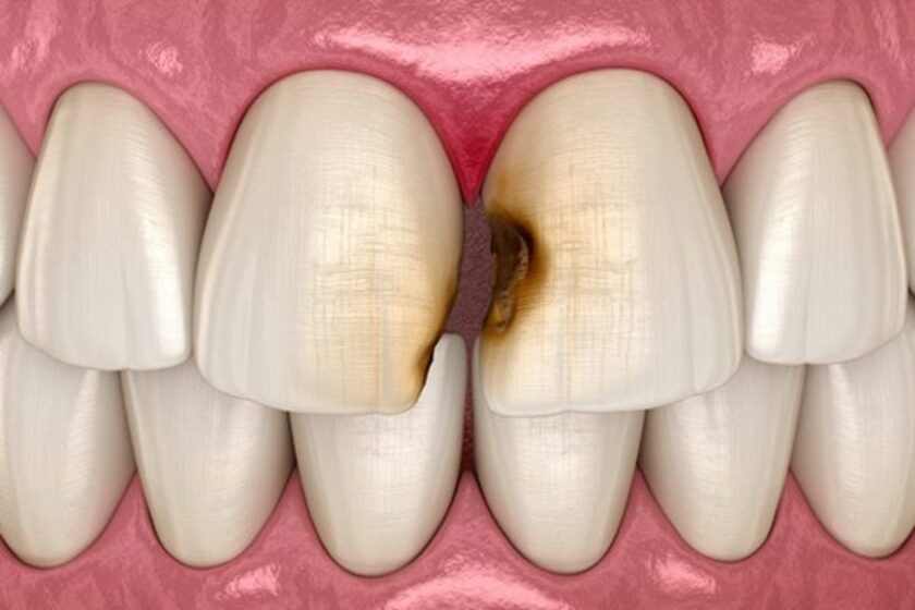 Răng bị đen ở kẽ ảnh hưởng đến thẩm mỹ của gương mặt