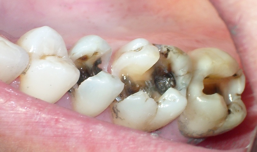 Sâu răng khiến răng bị lung lay