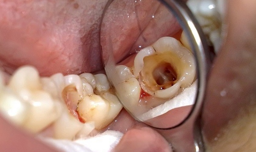 Răng cấm bị sâu có nên nhổ không? Nguy hiểm thế nào? 
