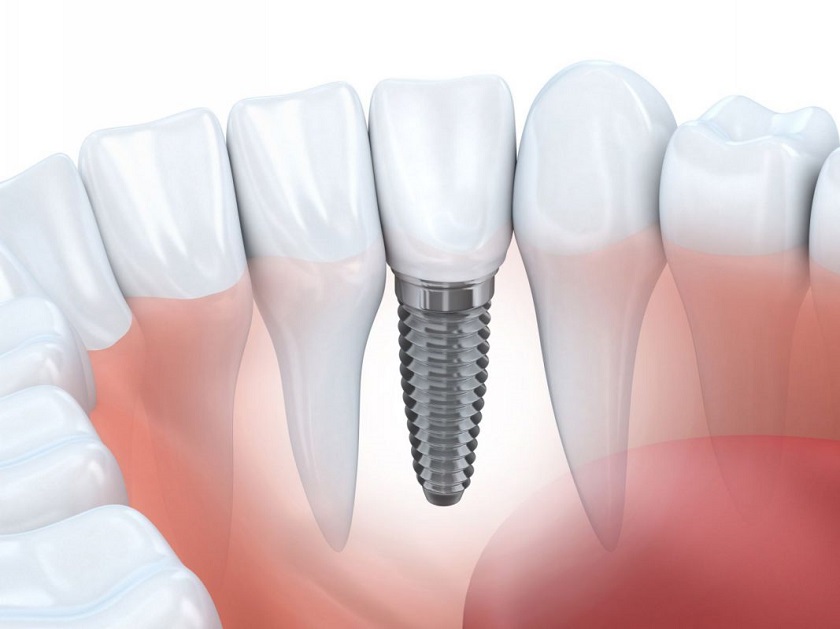 Cấy ghép implant cho răng cấm