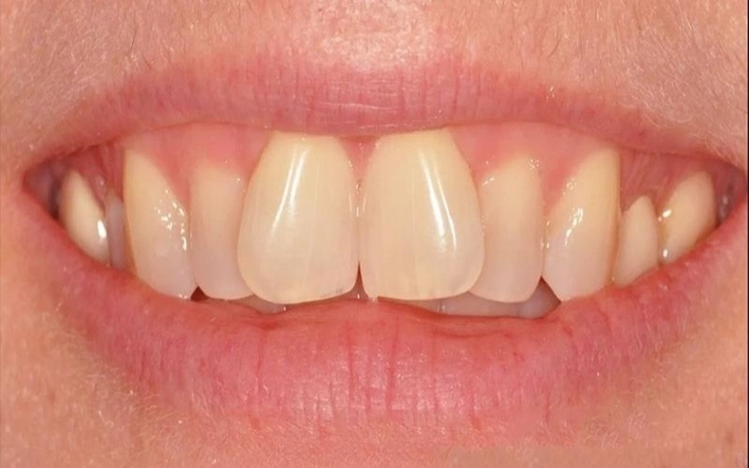 Tình trạng răng cửa mọc lệch lạc ảnh hưởng lớn đến thẩm mỹ, chức năng của răng
