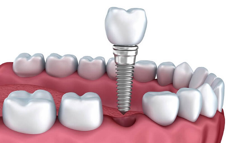 Răng đau sau khi trồng Implant: Nguyên nhân và điều trị