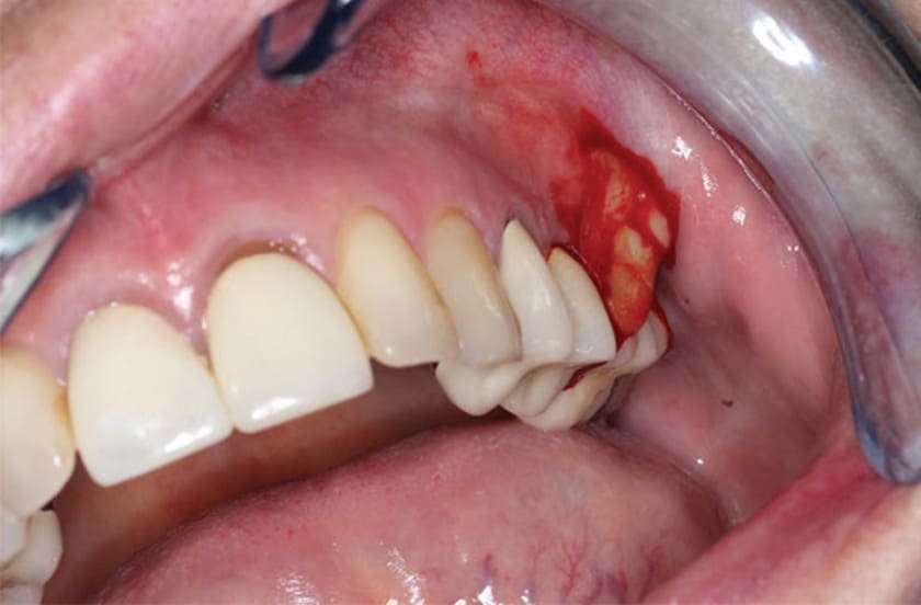 Các bệnh lý răng miệng nếu không được điều trị trước khi cắm implant có thể gây đau