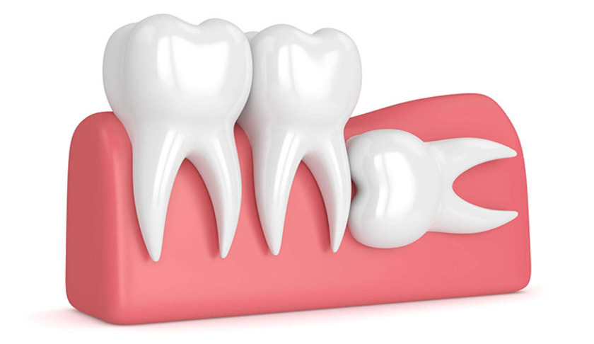 Răng mọc ngầm có xu hướng mọc sâu vào trong xương hàm