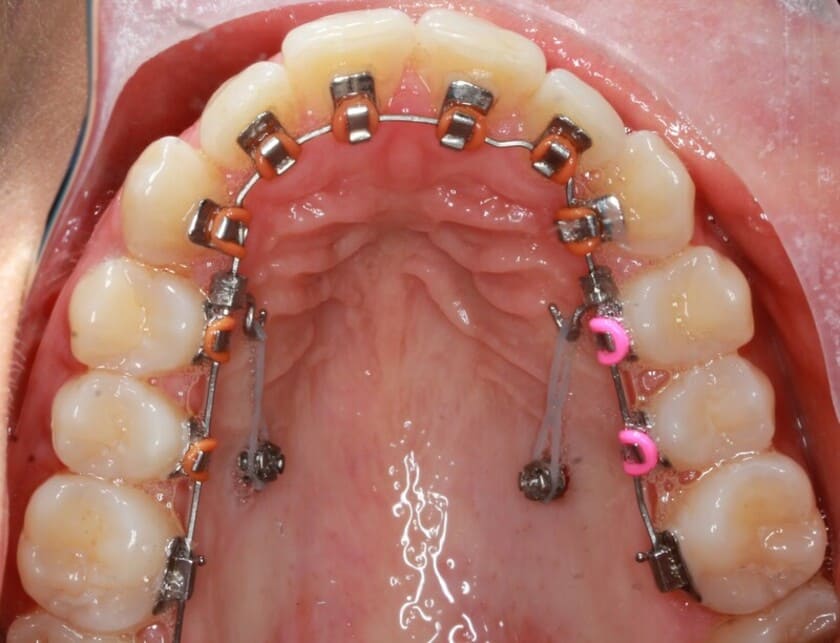 Phương pháp niềng răng kéo răng mọc ngầm cũng khá phổ biến
