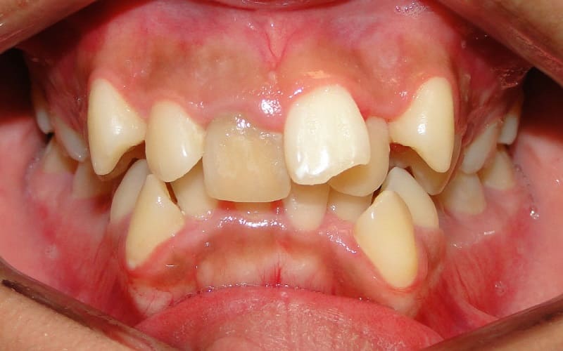 Răng mọc trên lợi có hại như thế nào? Các cách xử lý triệt để