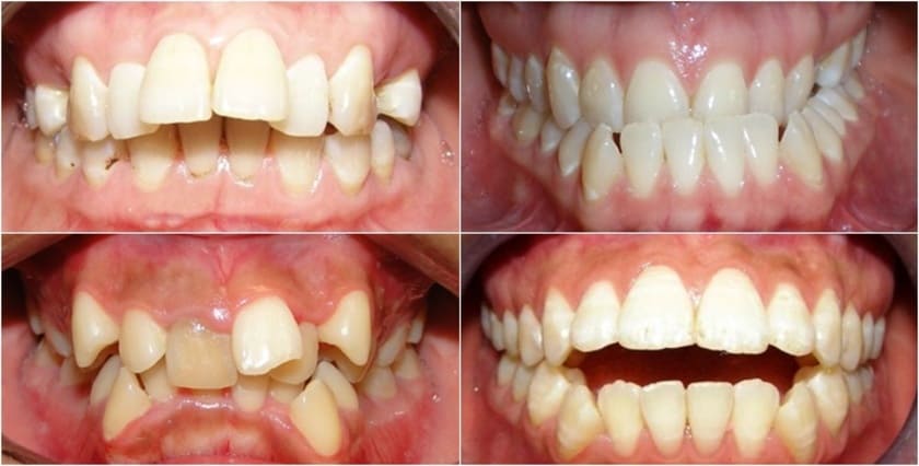 Mọc răng ngược trên lợi thường bị lệch ra ngoài cung hàm và có xu hướng mọc cao hơn các răng còn lại