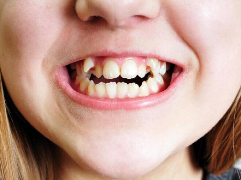 Răng mọc trên lợi có thể gây mất thẩm mỹ