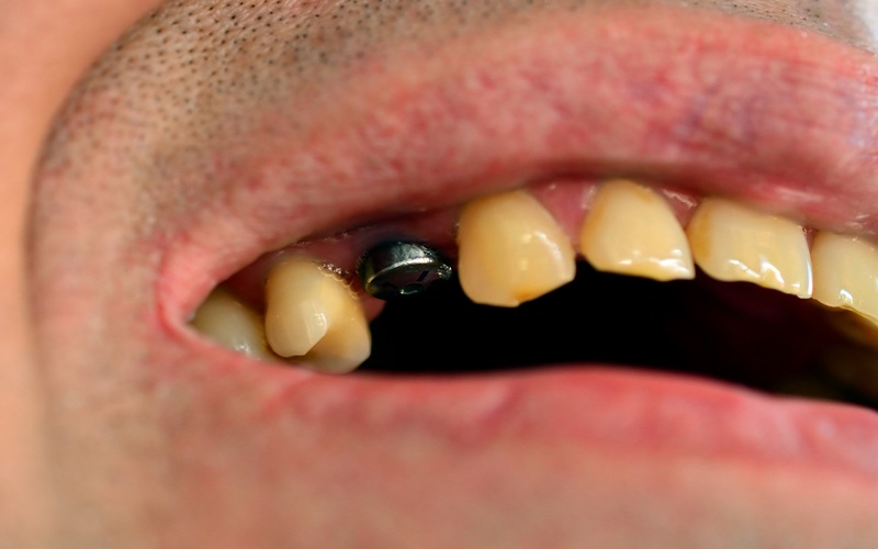 Mất răng số 4 có nguy hiểm không? Điều trị thế nào?