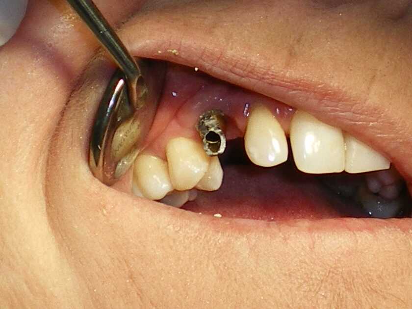 Trồng răng implant là giải pháp hoàn hảo để phục hình răng số 4