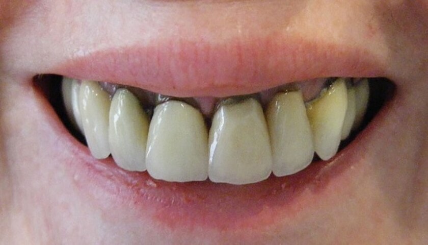 Răng sứ kém chất lượng cũng là một tác nhân gây ê nhức răng sau khi bọc sứ