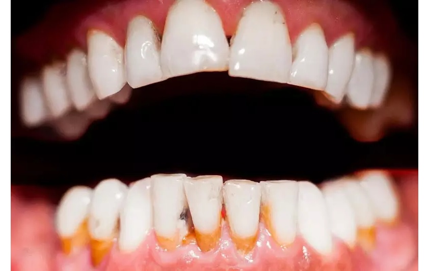 Tụt lợi khiến cho răng sứ dễ đổi màu khi ăn uống