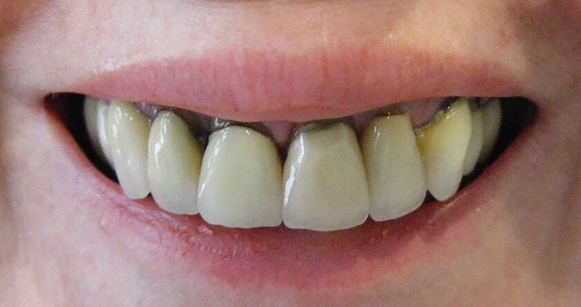 Răng sứ titan có thể bị hư hỏng sau một thời gian sử dụng