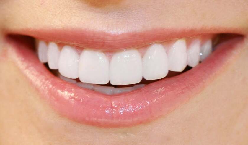 Cách duy nhất để khắc phục răng titan bị đen là thay thế bằng một mão răng sứ mới