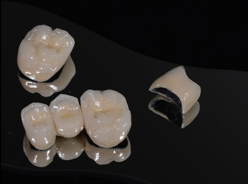 Răng sứ titan được sử dụng phổ biến