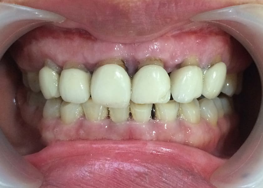 Răng sứ titan sẽ xuất hiện hiện tượng oxy hóa sau một thời gian sử dụng