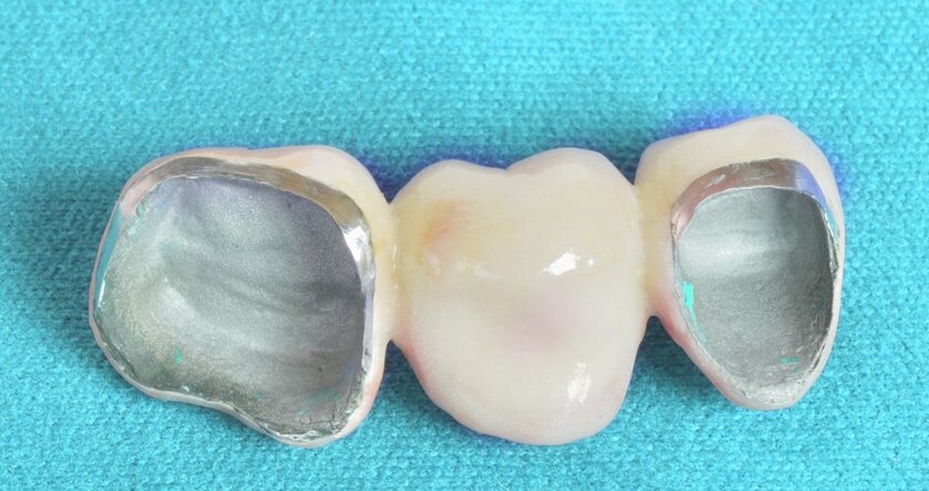 Nguồn gốc xuất xứ và chất lượng của răng sứ titan có ảnh hưởng lớn tuổi thọ của chúng
