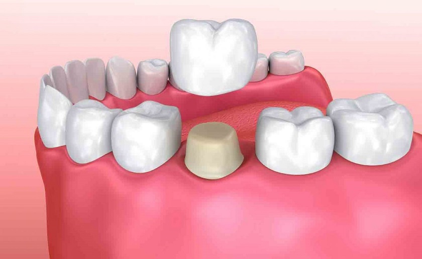 Bọc răng sứ có thể gây xâm lấn răng thật