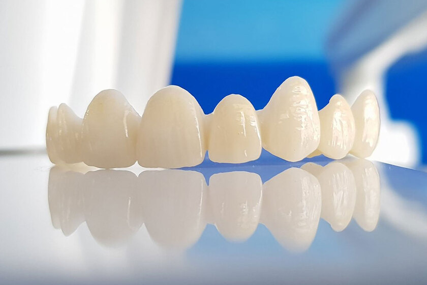 Răng sứ Zirconia là loại răng sứ phổ biến nhất trong nha khoa thẩm mỹ hiện nay