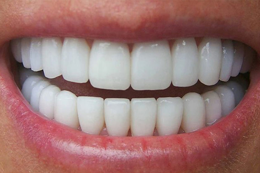 Răng sứ Zirconia sở hữu nhiều ưu điểm vượt trội