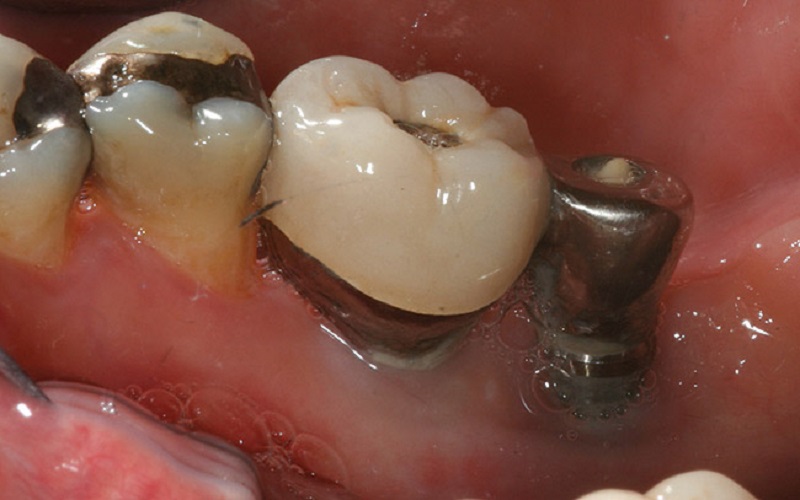 Những rủi ro khi trồng răng implant có thể xảy ra