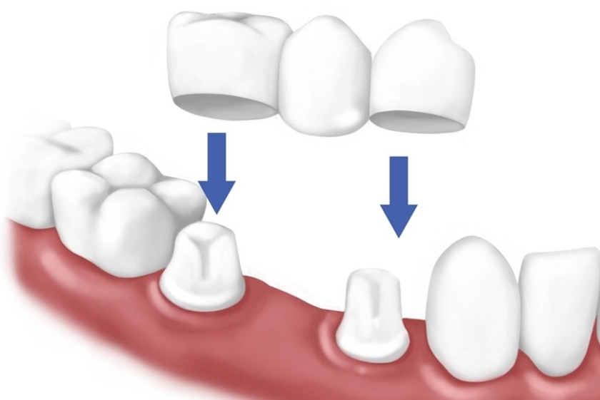 Cầu răng sứ có thể làm tiêu xương dẫn đến tụt nướu