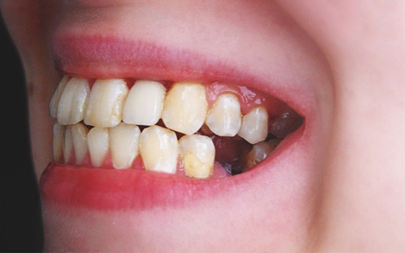 Bị rụng răng cấm: Nguyên nhân và phương pháp phục hình