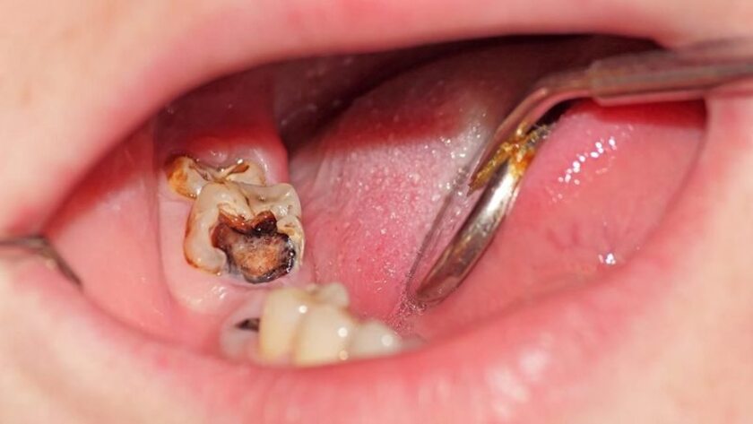 Răng cấm tự rụng phần lớn là do nguyên nhân mắc các bệnh lý răng miệng