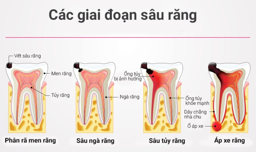 Sâu răng nặng là tình trạng răng bị tổn thương nghiêm trọng do vi khuẩn tấn công