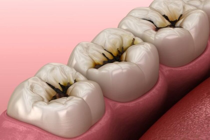 Dấu hiệu nhận biết răng đã bị sâu nặng là các lỗ đen bám chặt trên bề mặt răng