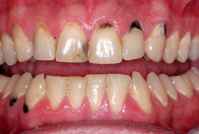 Sâu răng nặng còn ảnh hưởng đến thẩm mỹ