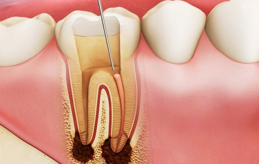 Lấy tủy răng là phương pháp điều trị bảo tồn răng bị sâu hoặc nhiễm trùng nặng
