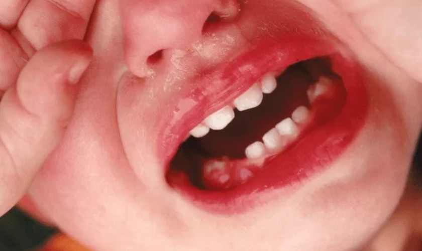 Sưng mộng răng ở trẻ em