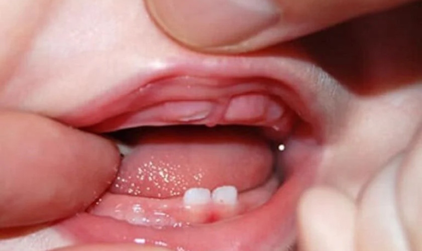 Sưng mộng răng ở trẻ em do mọc răng khá phổ biến