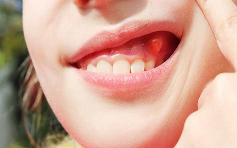 Sưng nướu răng có mủ: Nguyên nhân và cách điều trị