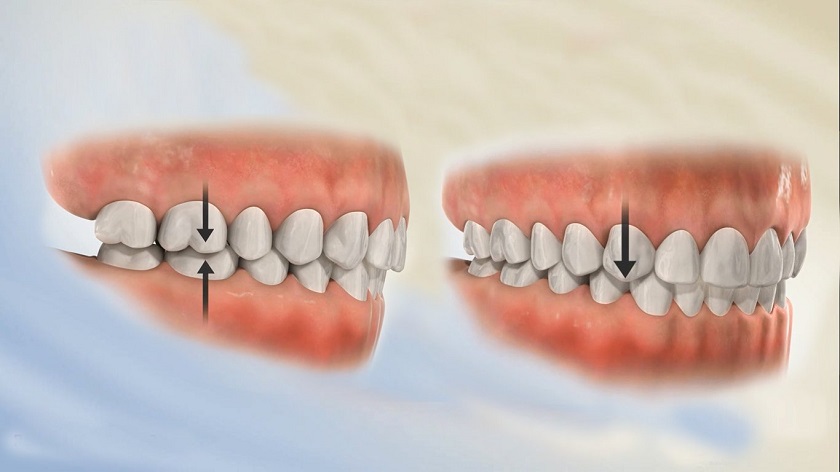 Ảnh hưởng xấu của lệch khớp cắn lên răng implant