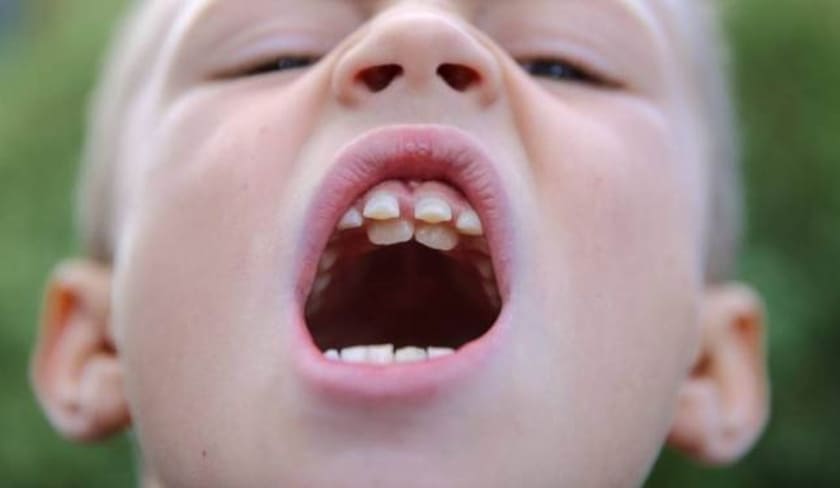 Chậm mọc răng có ảnh hưởng tiêu cực nếu không được can thiệp kịp thời
