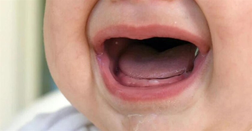 Việc trẻ mọc răng sớm hơn các bé cùng tuổi là điều bình thường