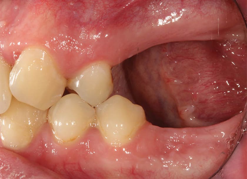 Mất răng lâu ngày mà không được khắc phục gây ra tình trạng tiêu xương hàm