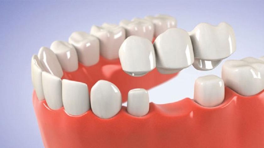 Nhược điểm của phương pháp cầu răng sứ là phải mài răng bên cạnh răng mất