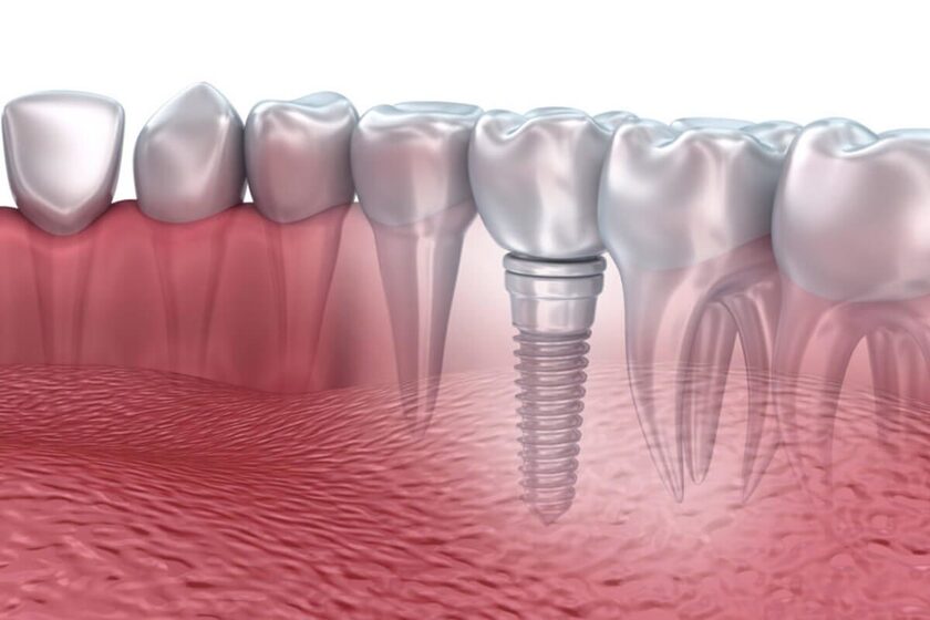 Cấy ghép implant là kỹ thuật dùng chân răng nhân tạo để thay thế chân răng đã mất