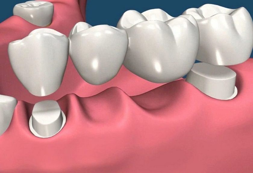 Cầu răng sứ phù hợp với những trường hợp bị mất một hoặc hai răng liên tiếp