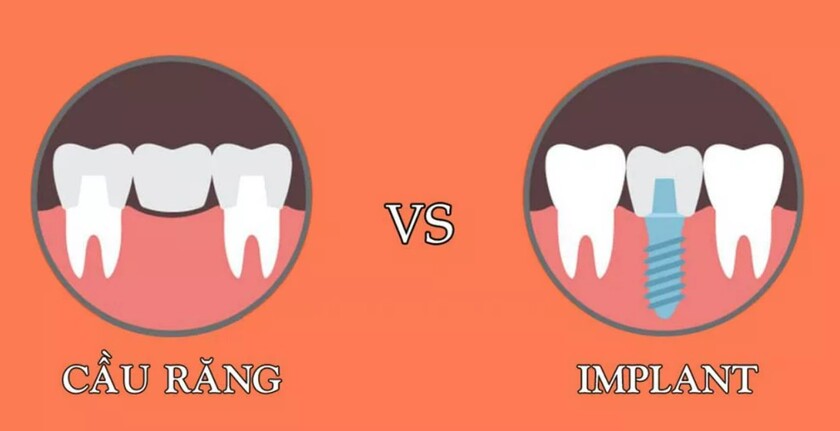 Giá trồng răng giả cố định tùy thuộc vào phương pháp bệnh nhân lựa chọn