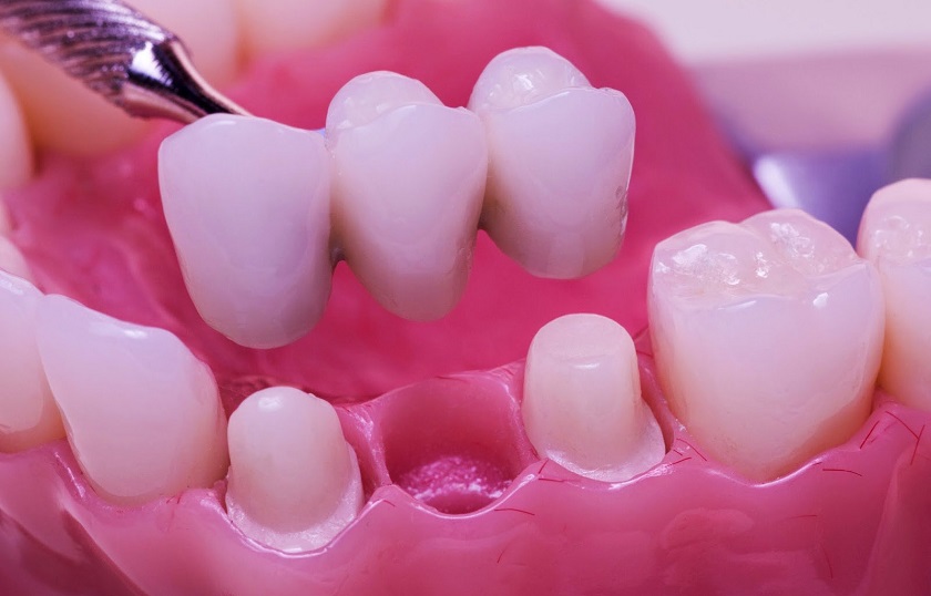 Hầu hết trường hợp lầm cầu răng sứ không thể niềng răng được
