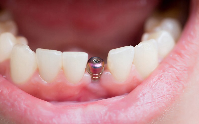 [Hỏi&Đáp] Trồng răng implant bao lâu thì lành?